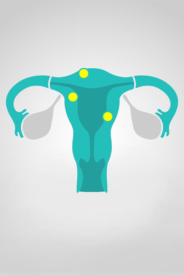 Fibroids-Treatment-Ledda-Achorage-Alaska Fibroids Treatment Ledda Soldotna Anchorage Alaska